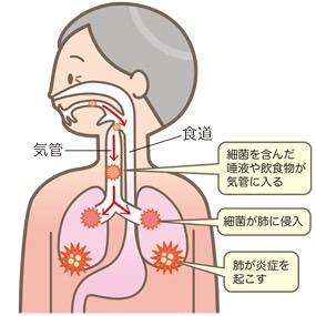 誤嚥性肺炎