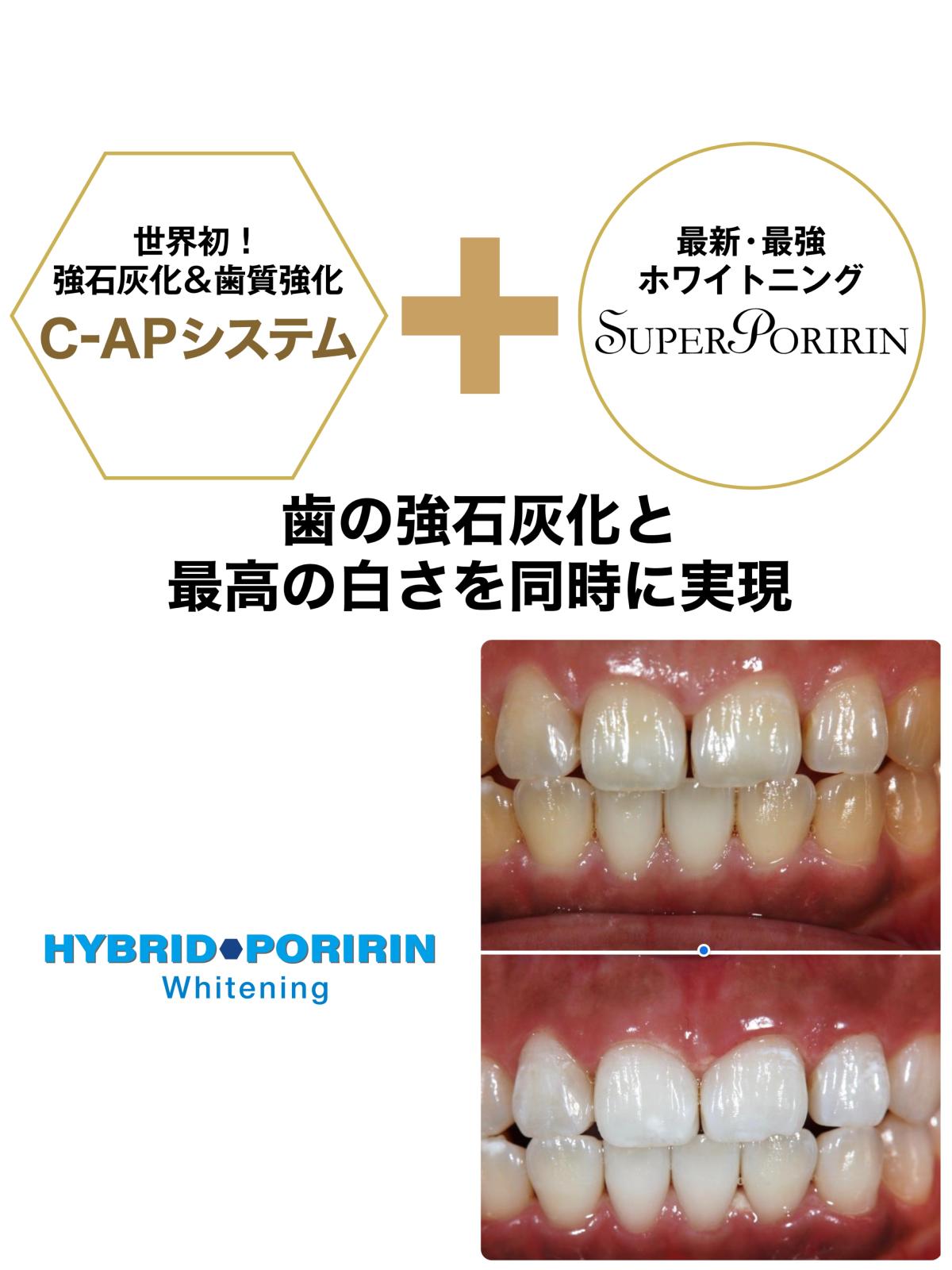 ホワイトニング