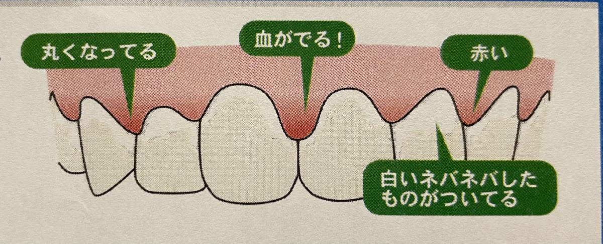 歯肉炎