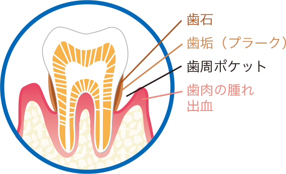 歯周病